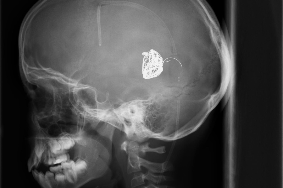 An MRI imaging showing the condition of my shunt at eight years old.